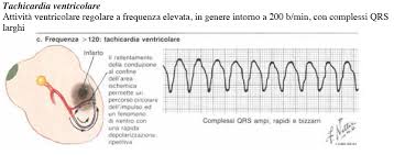 QRS Largo